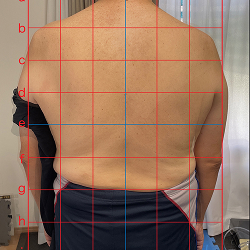 テーピングによる肩の調整の施術前